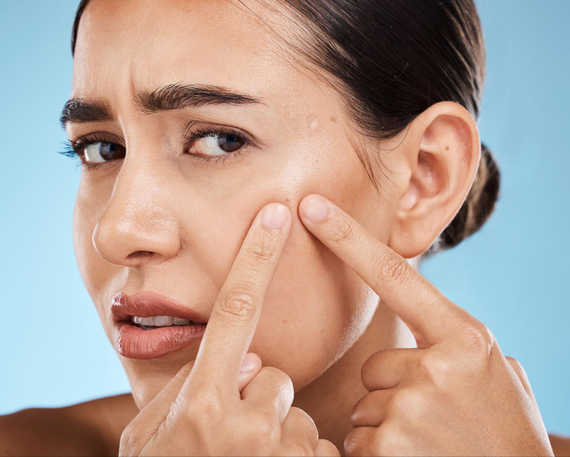 acne hormonal causas