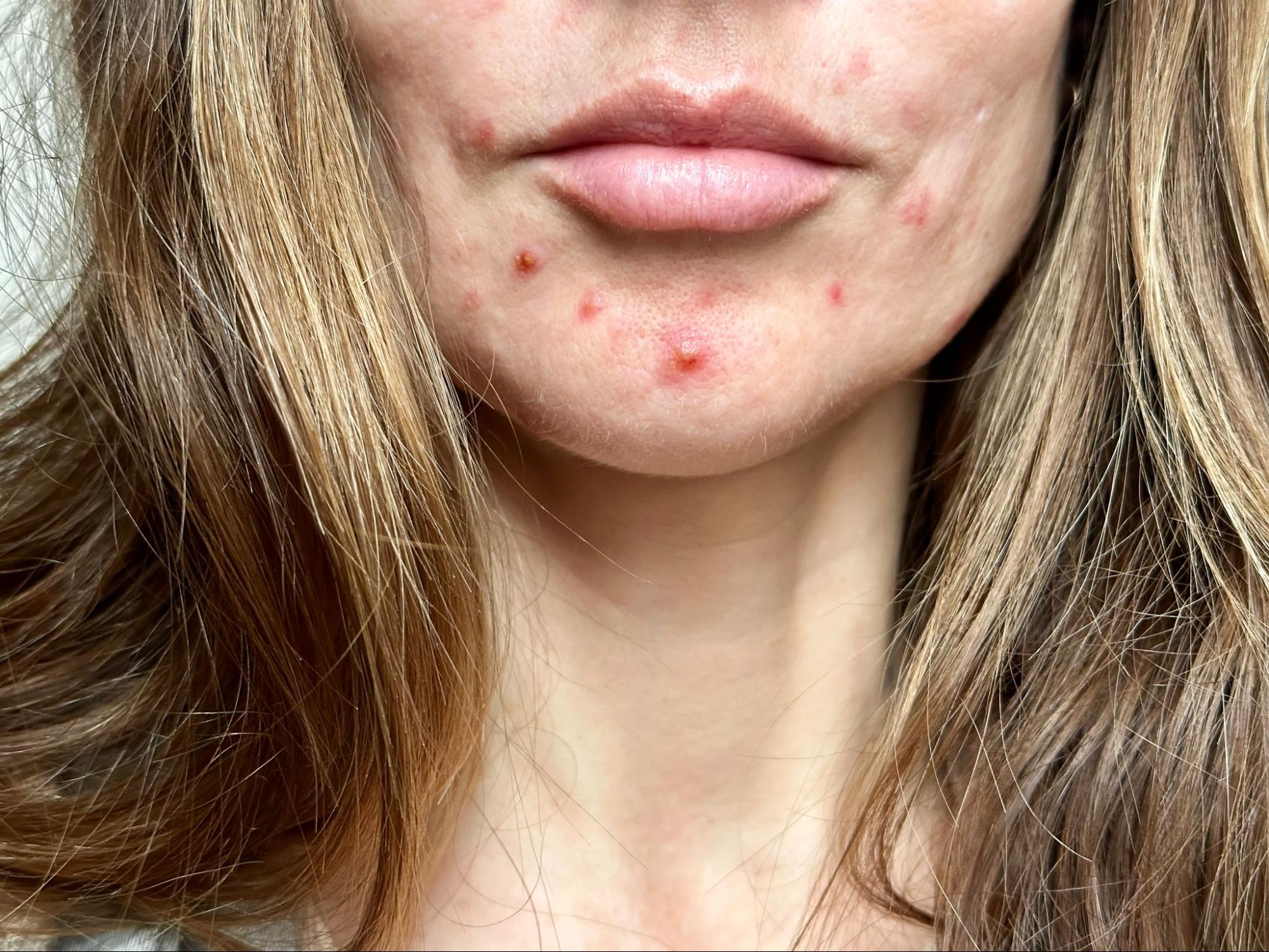 acne hormonal edad