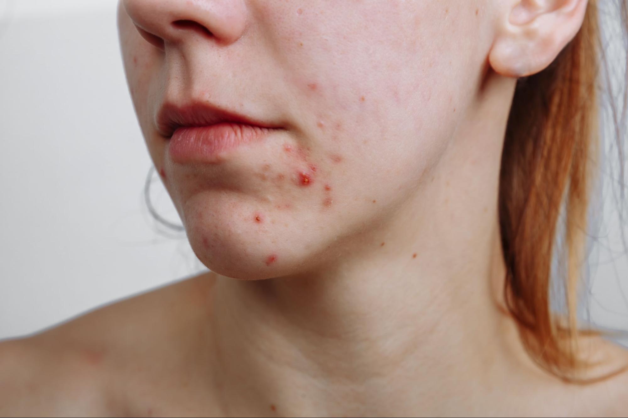 acne hormonal que es