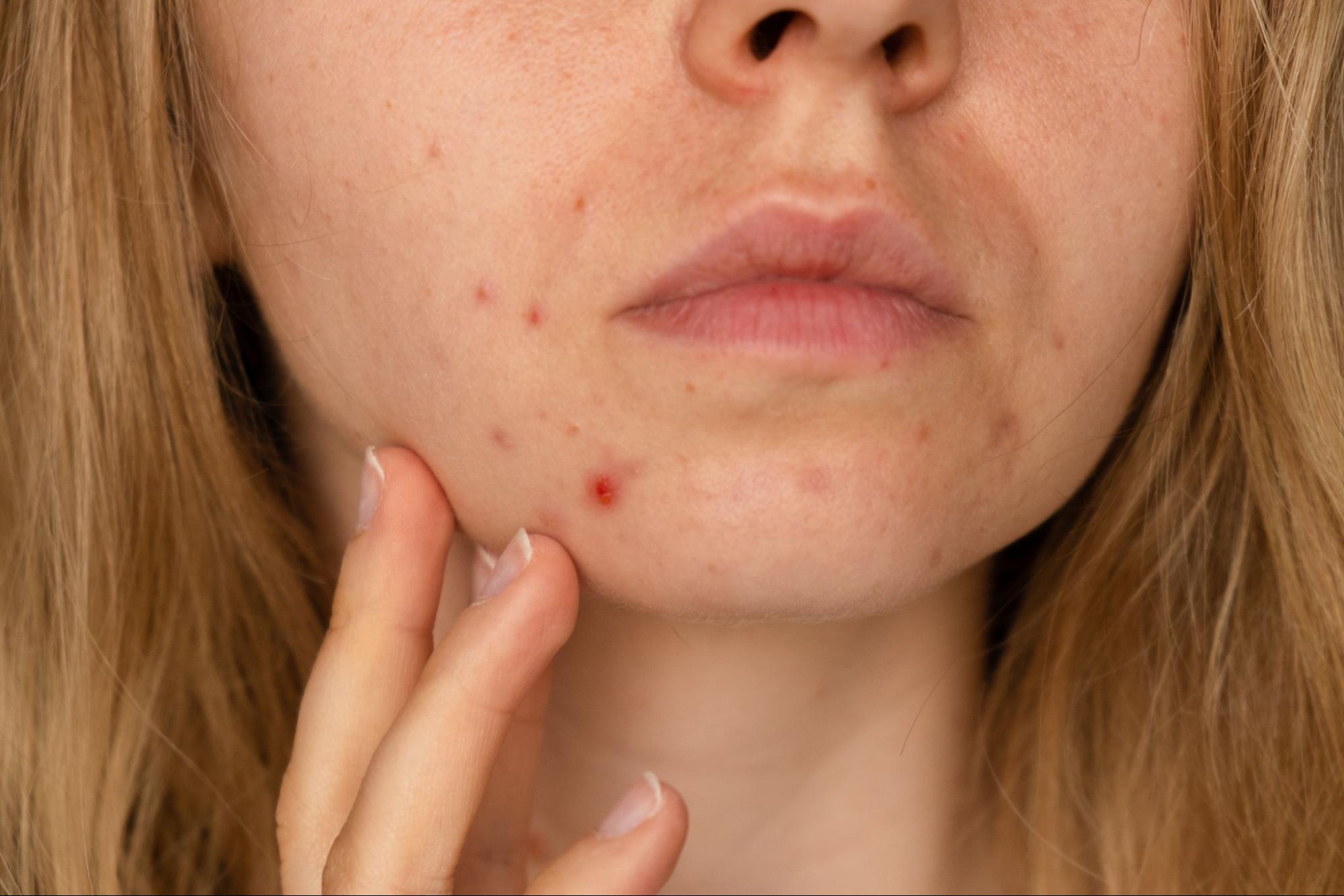 acne hormonal tratamientos